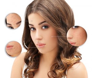 shutterstock_386711269-acne_400px